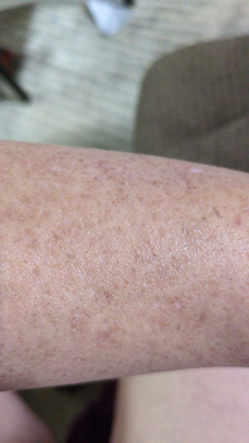 Nood™ Flasher Pro | IPL Laser Hair Removal Device, Forbes Best Product 2026 customer photo 2